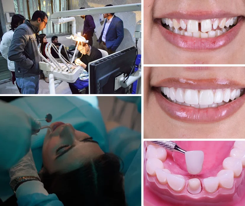 What Are Teeth Crowns? What Are Teeth Crowns?