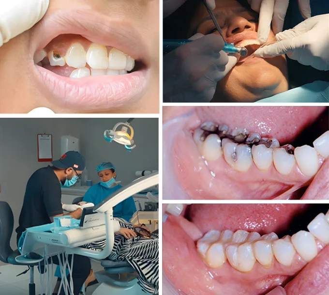 What Is a Dental Filling? What Is a Dental Filling?