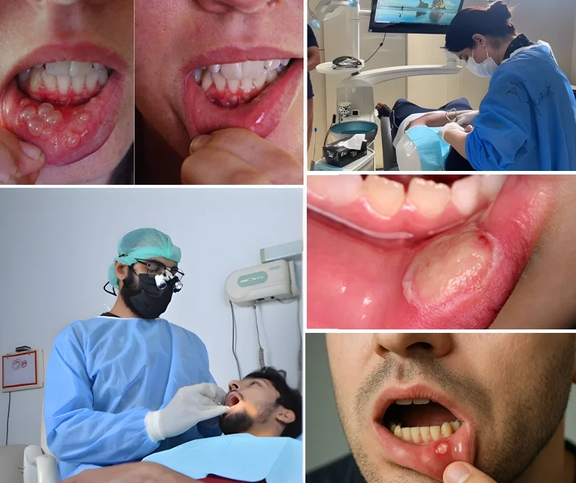 What Causes Mouth Ulcers? What Causes Mouth Ulcers?
