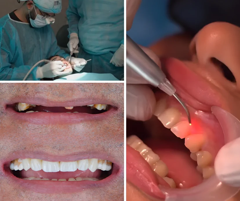 What Causes a Chipped or Broken Tooth? What Causes a Chipped or Broken Tooth?