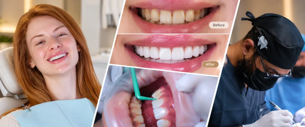 Hollywood Smile before and after results
