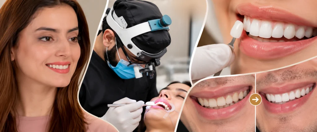 Porcelain Veneers Before and After
