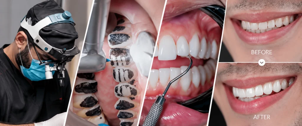 What Do Porcelain Veneers Correct
