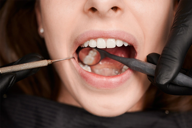 Dental-Crowns-Bridges