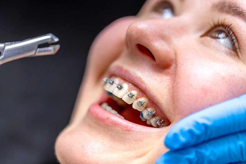 Traditional-Braces