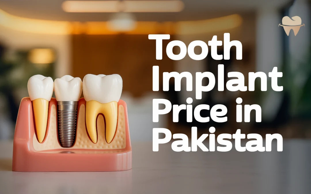 Tooth Implant Price in Pakistan: An Overview