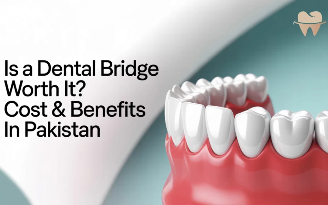Is a Dental Bridge Worth It? Cost & Benefits in Pakistan
