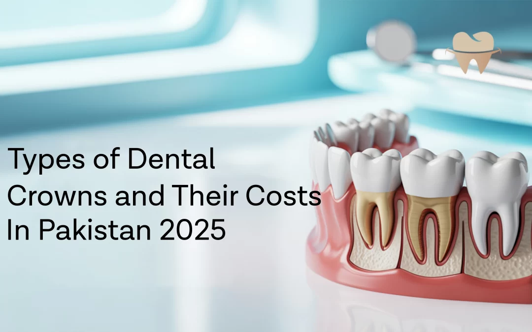 Types of Dental Crowns and Their Costs in Pakistan 2025