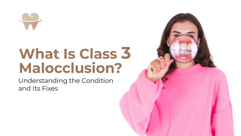 What Is Class 3 Malocclusion? What Is Class 3 Malocclusion?