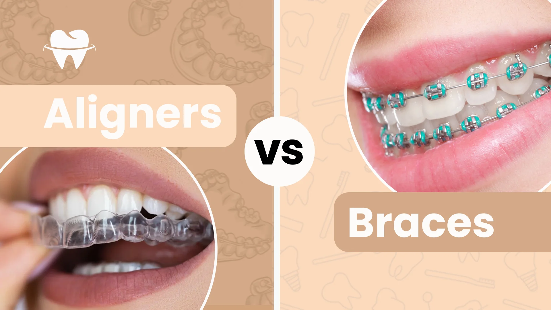 Aligners vs Braces