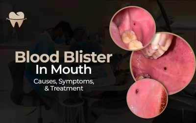 Blood Blister in Mouth – Causes, Symptoms, and Treatment