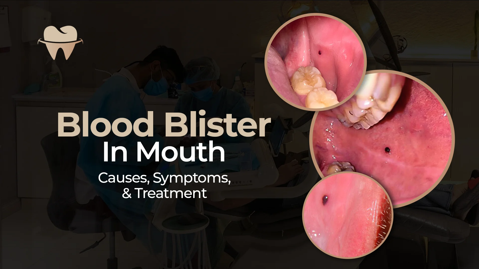 Blood Blister in Mouth