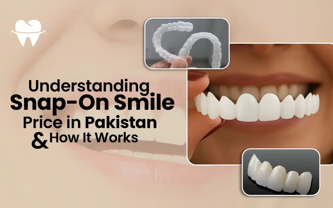 Understanding Snap-On Smile Price in Pakistan and How It Works