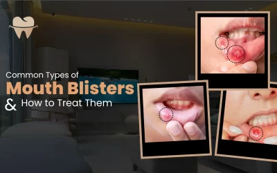 Common Types of Mouth Blisters and How to Treat Them
