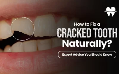 How To Fix a Cracked Tooth Naturally? Expert Advice You Should Know
