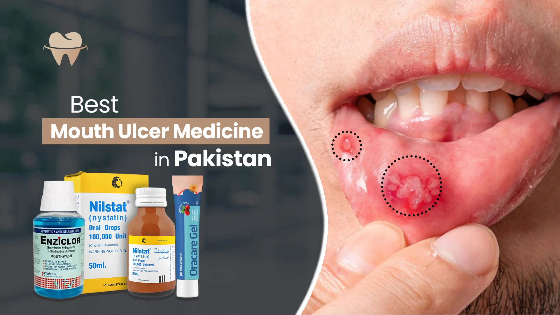 Mouth Ulcer Medicine in Pakistan
