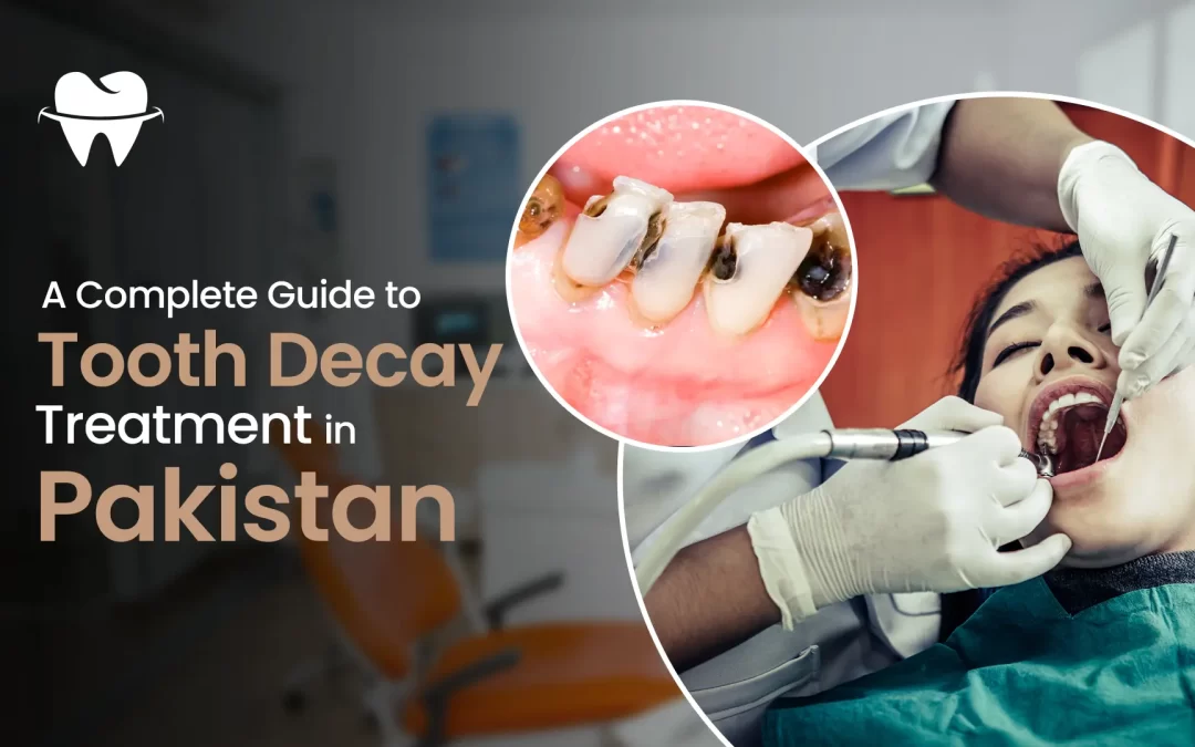 A Complete Guide to Tooth Decay Treatment in Pakistan
