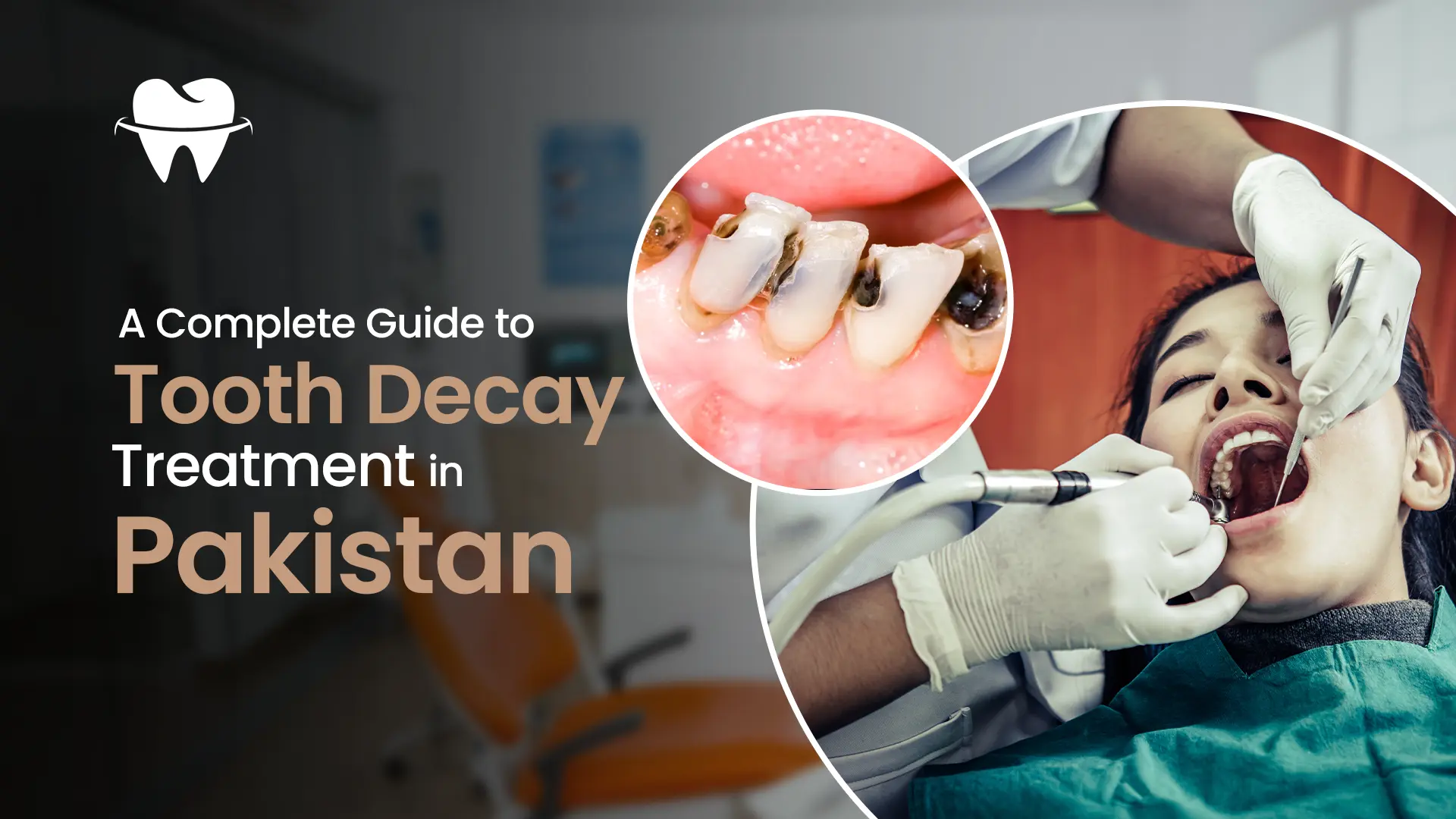 Tooth Decay Treatment in Pakistan Tooth Decay Treatment in Pakistan