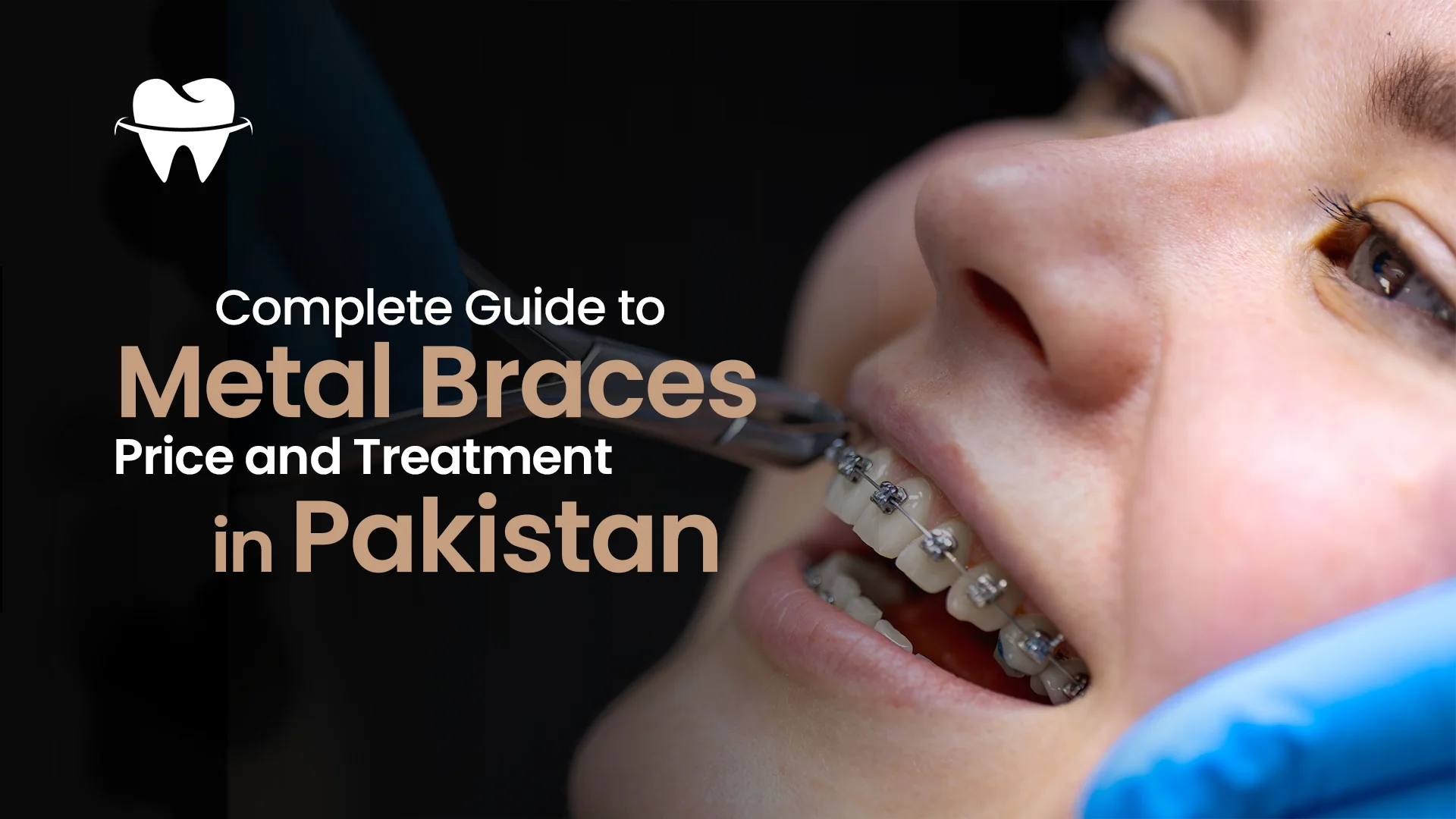 Metal Braces Price and Treatment in Pakistan