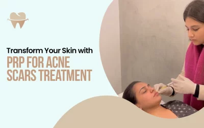 Transform Your Skin with PRP for Acne Scars Treatment