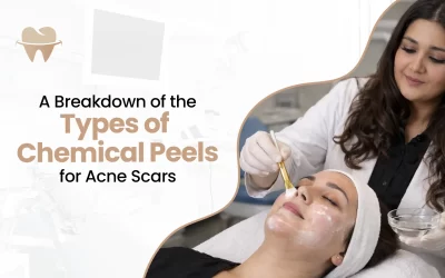 A Breakdown of the Types of Chemical Peels for Acne Scars