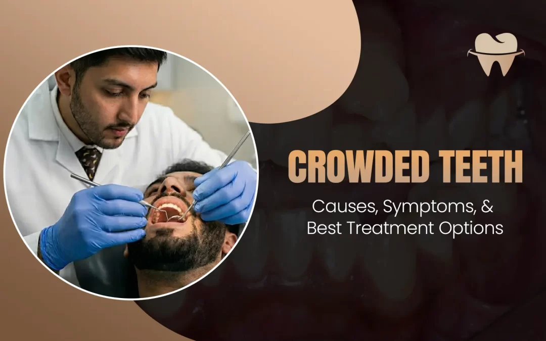 Crowded Teeth: Causes, Symptoms, and Best Treatment Options