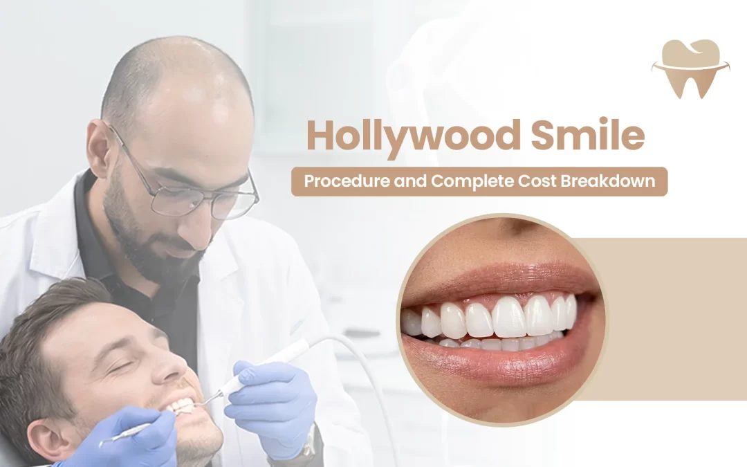 Hollywood Smile – Procedure and Complete Cost Breakdown