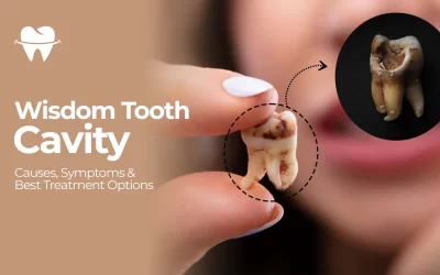 Wisdom Tooth Cavity: Causes, Symptoms & Best Treatment Options