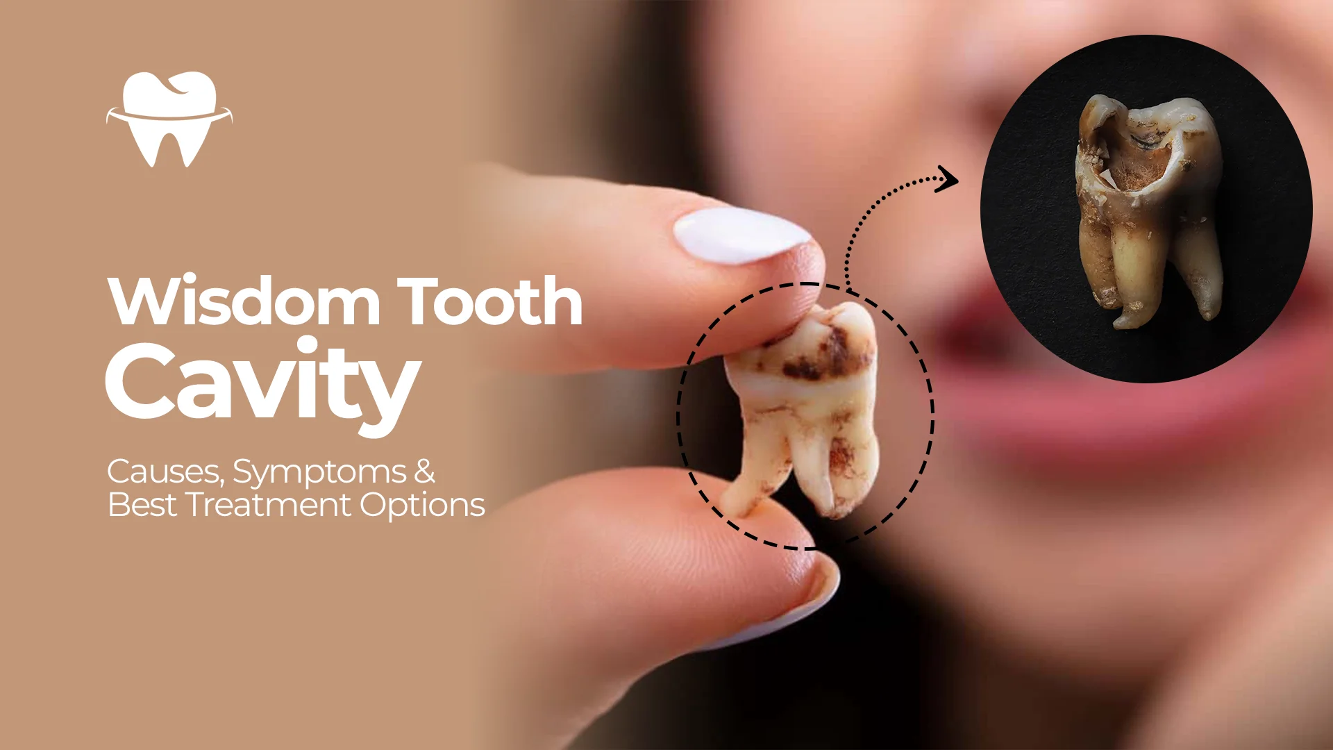 Wisdom-Tooth-Cavity