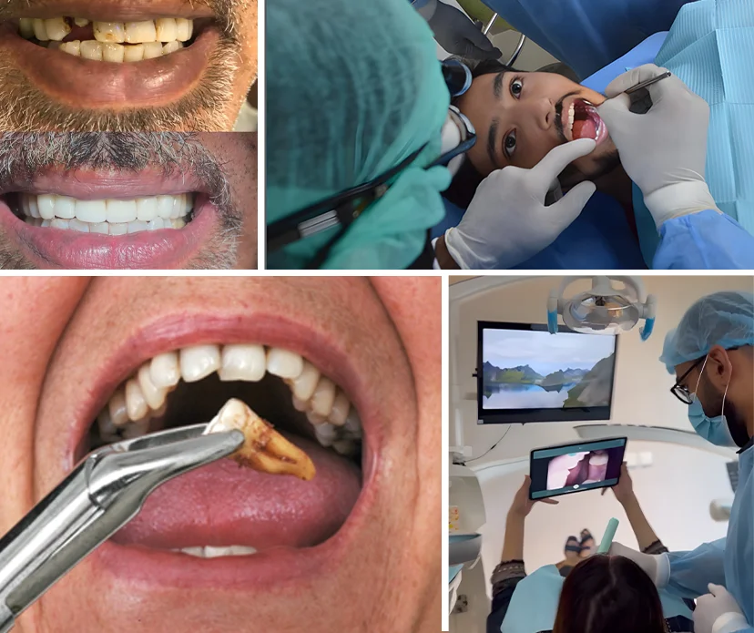 Exploring Tooth Extraction Exploring Tooth Extraction