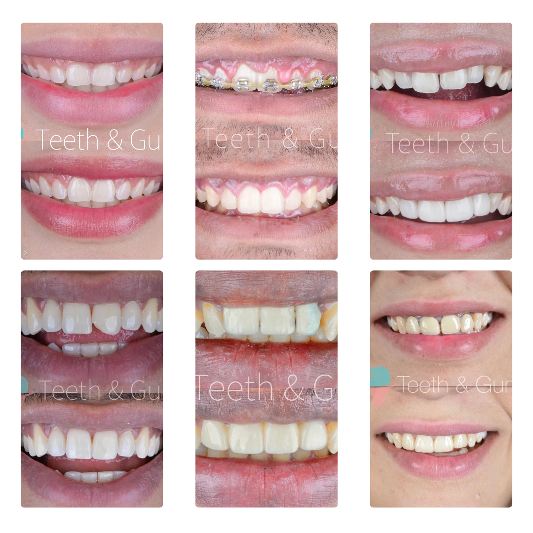 Invisalign