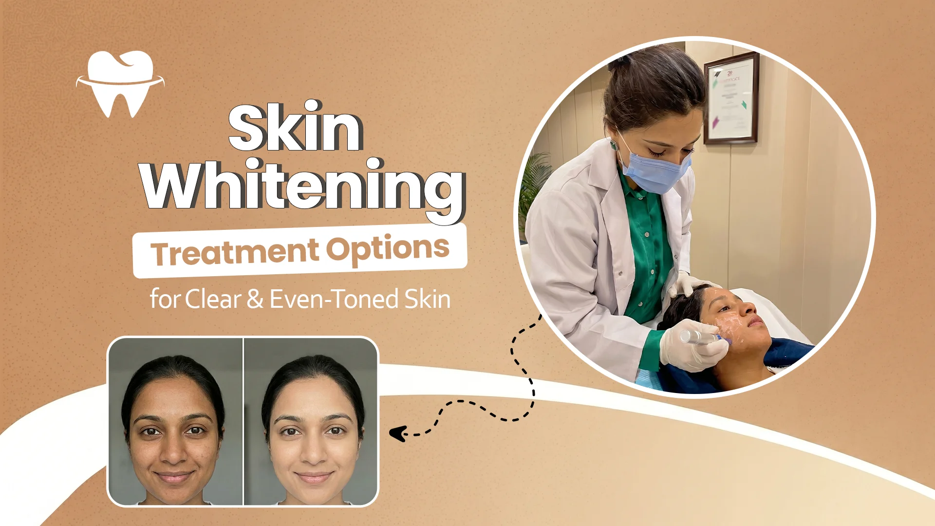 Skin Whitening Treatment Skin Whitening Treatment