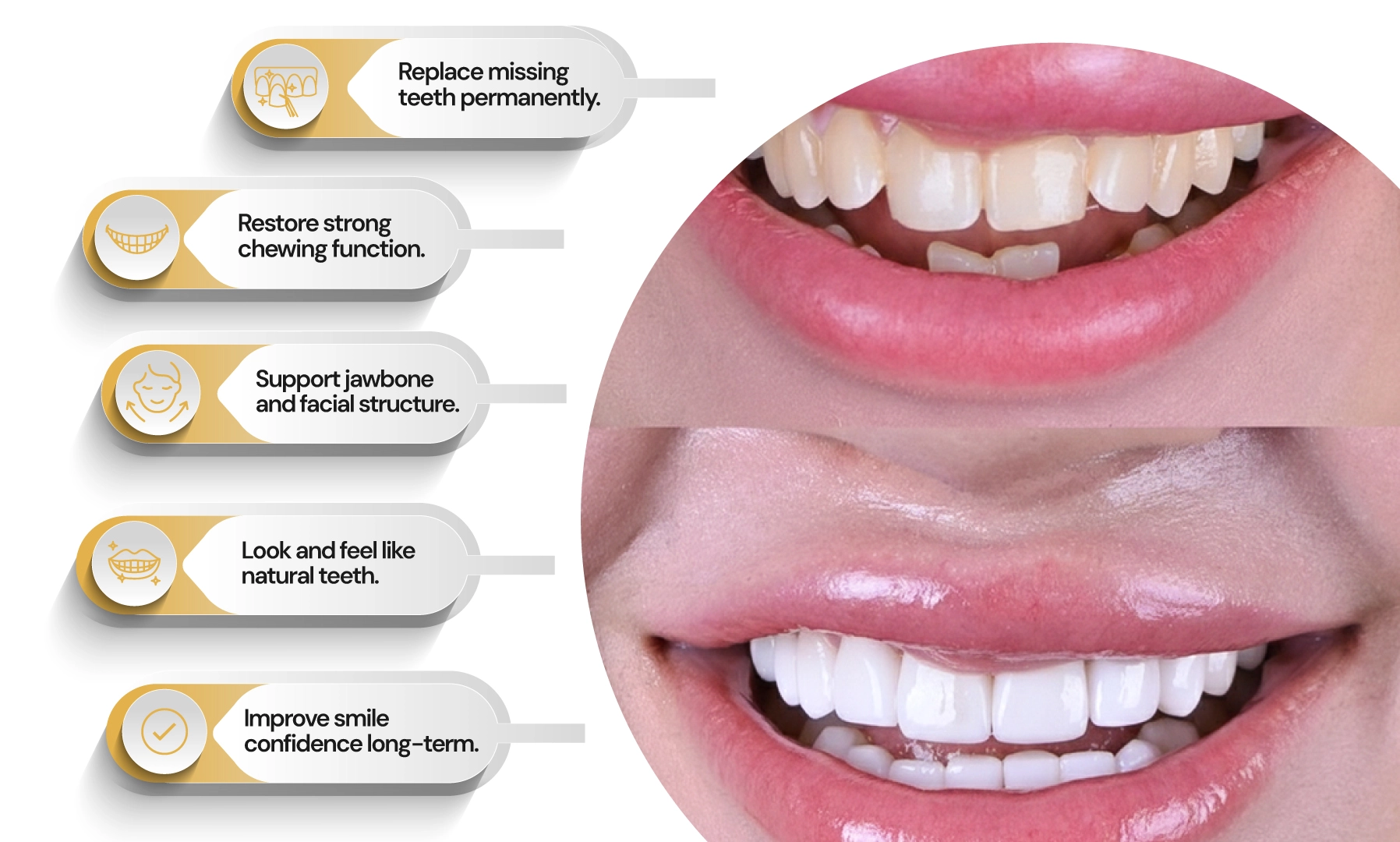 Benefits of Dental Implants Benefits of Dental Implants