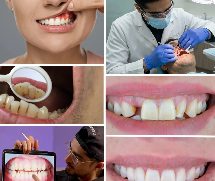 Understanding-Gum-Disease