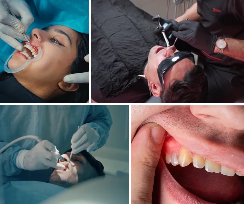 Understanding Tooth Abscess 