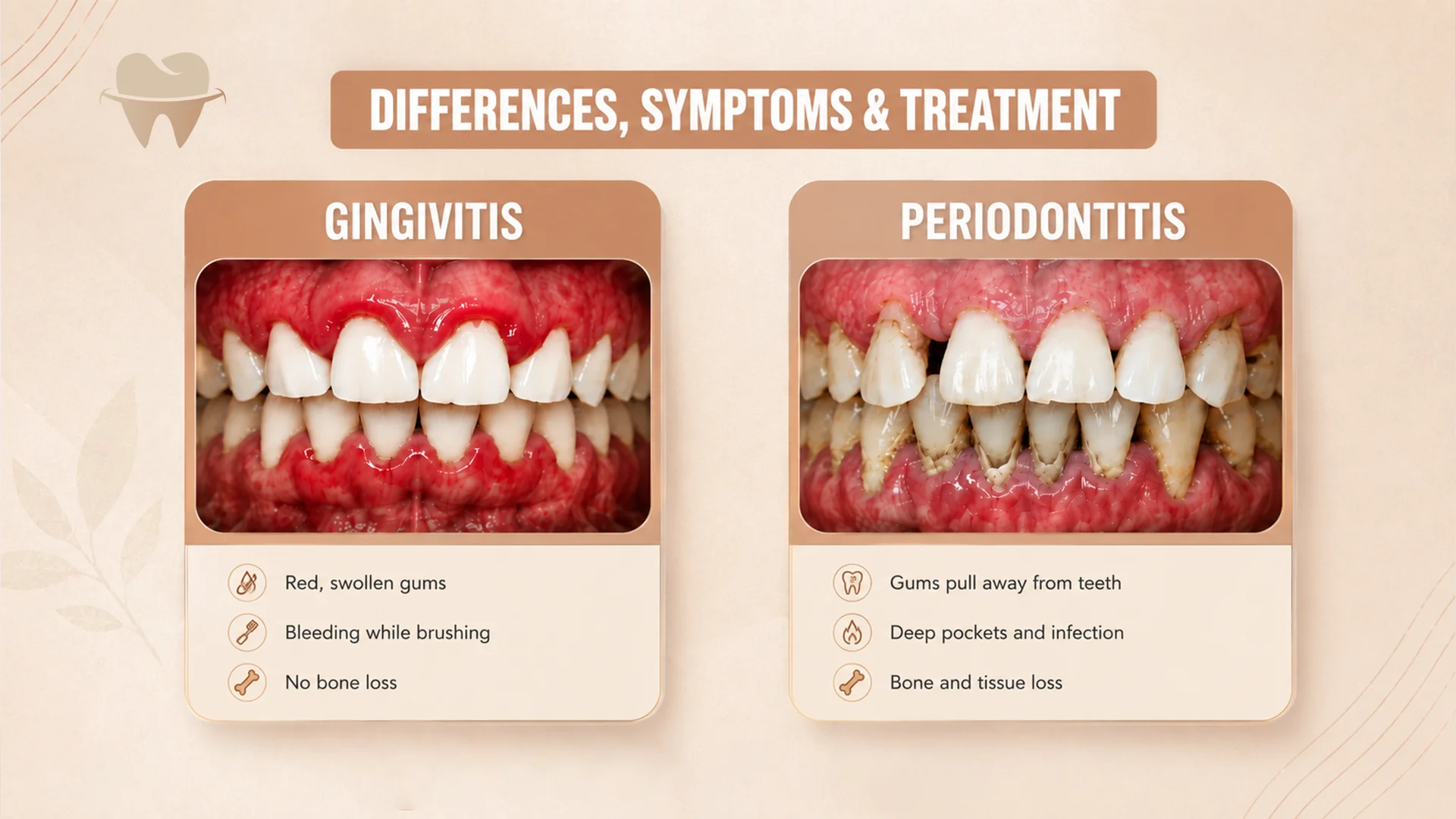 Gingivitis vs Periodontitis Gingivitis vs Periodontitis
