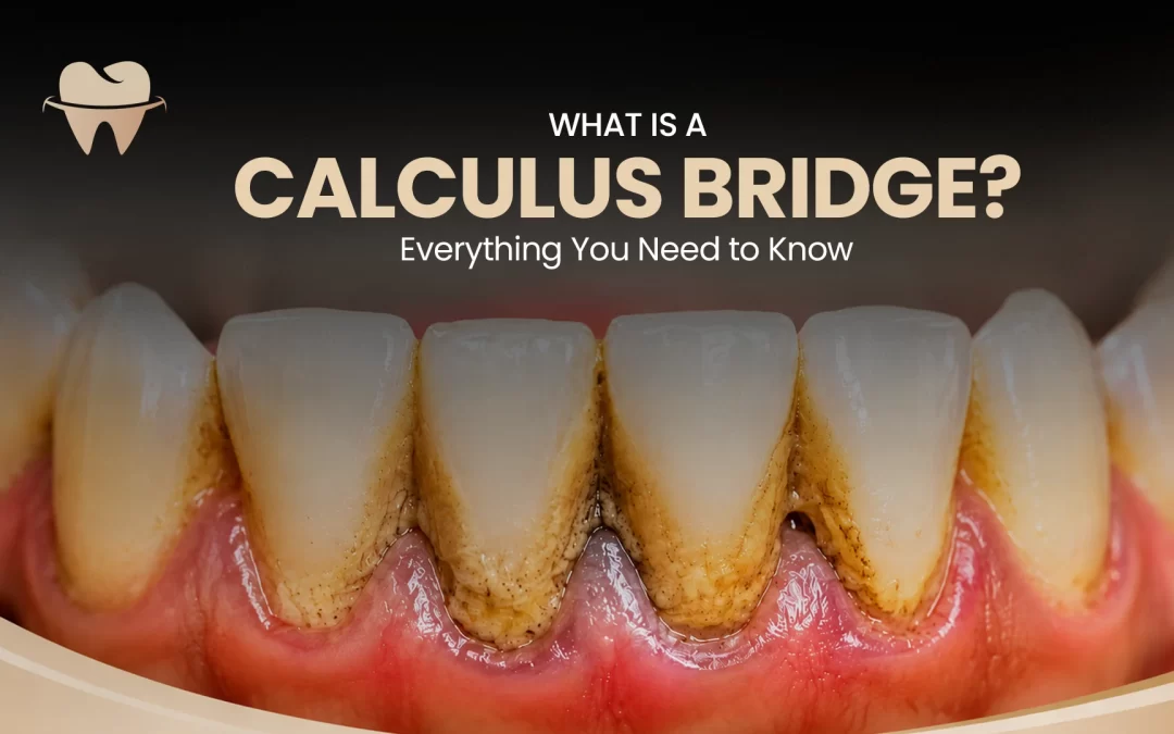 What Is a Calculus Bridge? Everything You Need to Know