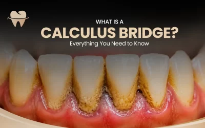 What Is a Calculus Bridge? Everything You Need to Know