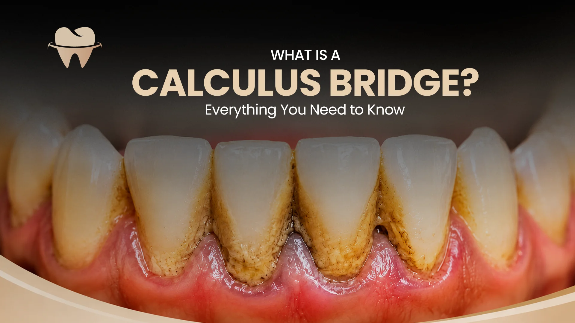What Is a Calculus Bridge What Is a Calculus Bridge