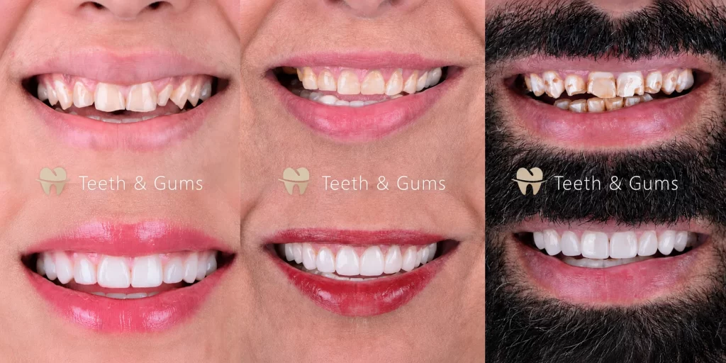 Teeth Scaling before and after