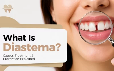 What Is Diastema? Causes, Treatment & Prevention Explained
