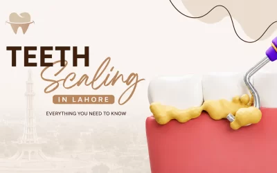 Teeth Scaling in Lahore: Everything You Need to Know