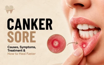 Canker Sore: Causes, Symptoms, Treatment and How to Heal Faster