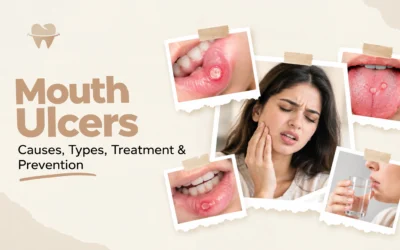 Mouth Ulcers: Causes, Types, Treatment and Prevention