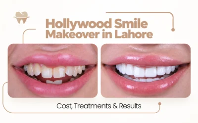 Hollywood Smile Makeover in Lahore: Cost, Treatments and Results