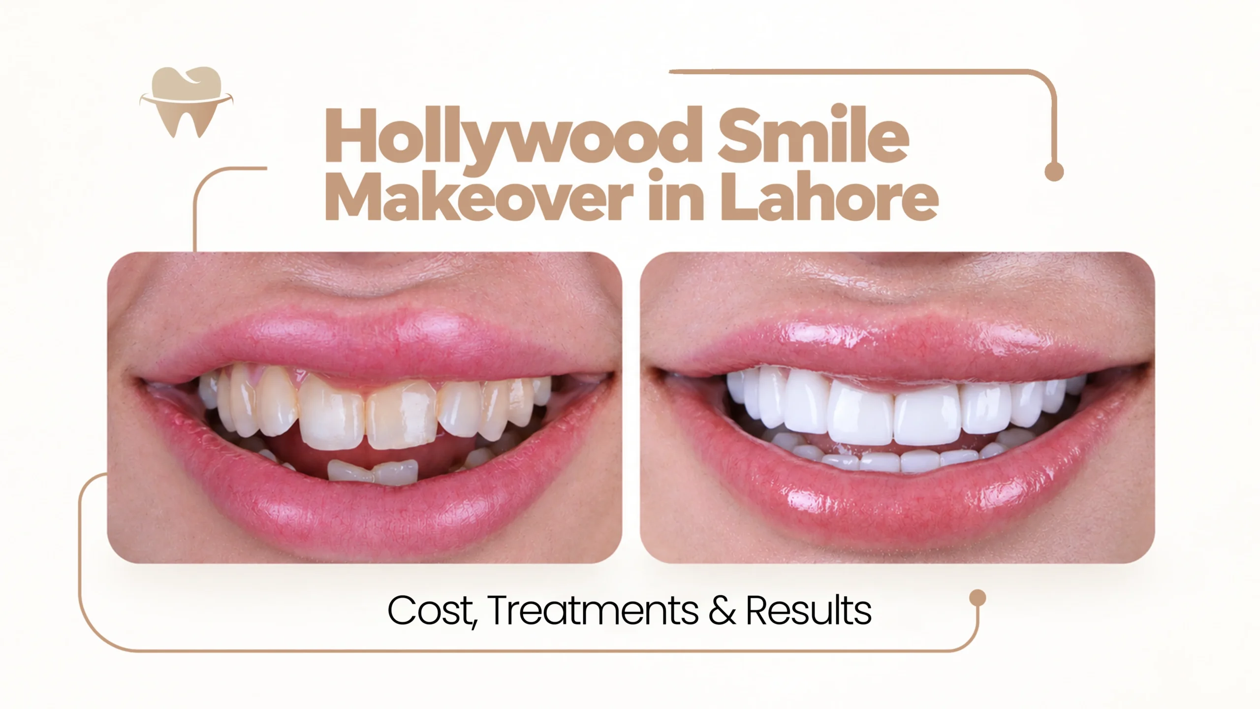 Hollywood Smile Makeover in Lahore Hollywood Smile Makeover in Lahore