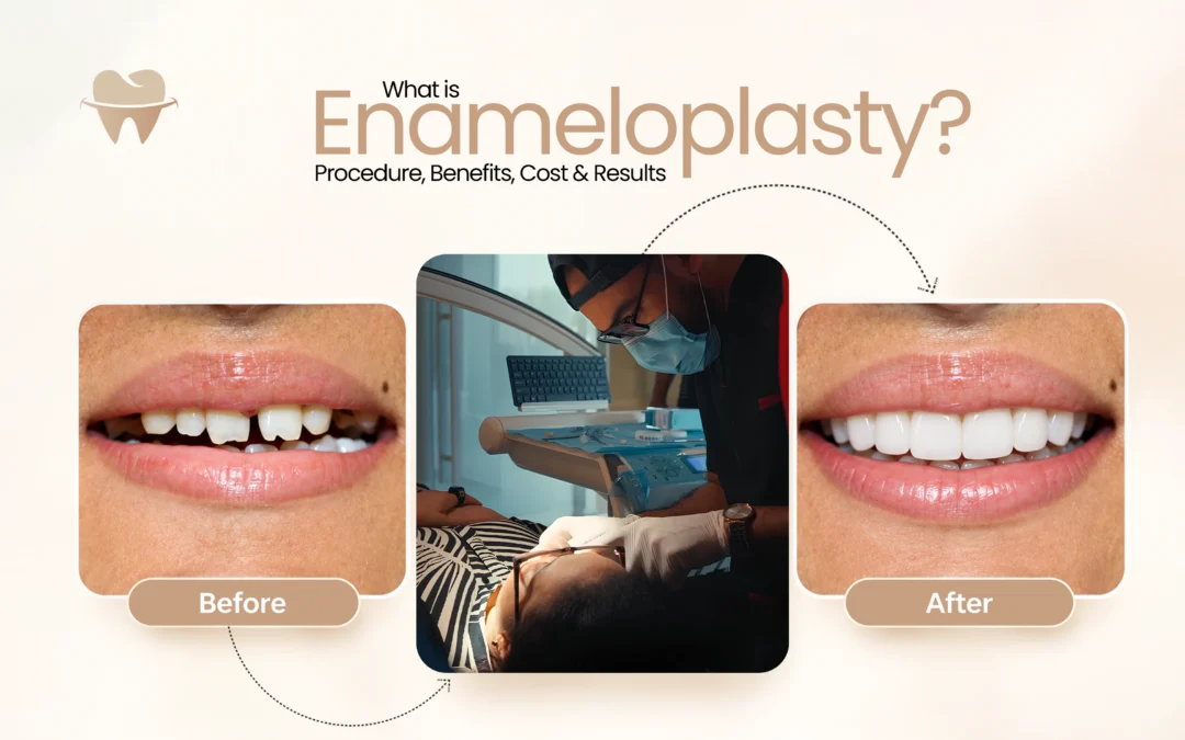 What Is Enameloplasty? Procedure, Benefits, Cost & Results