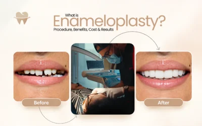 What Is Enameloplasty? Procedure, Benefits, Cost & Results