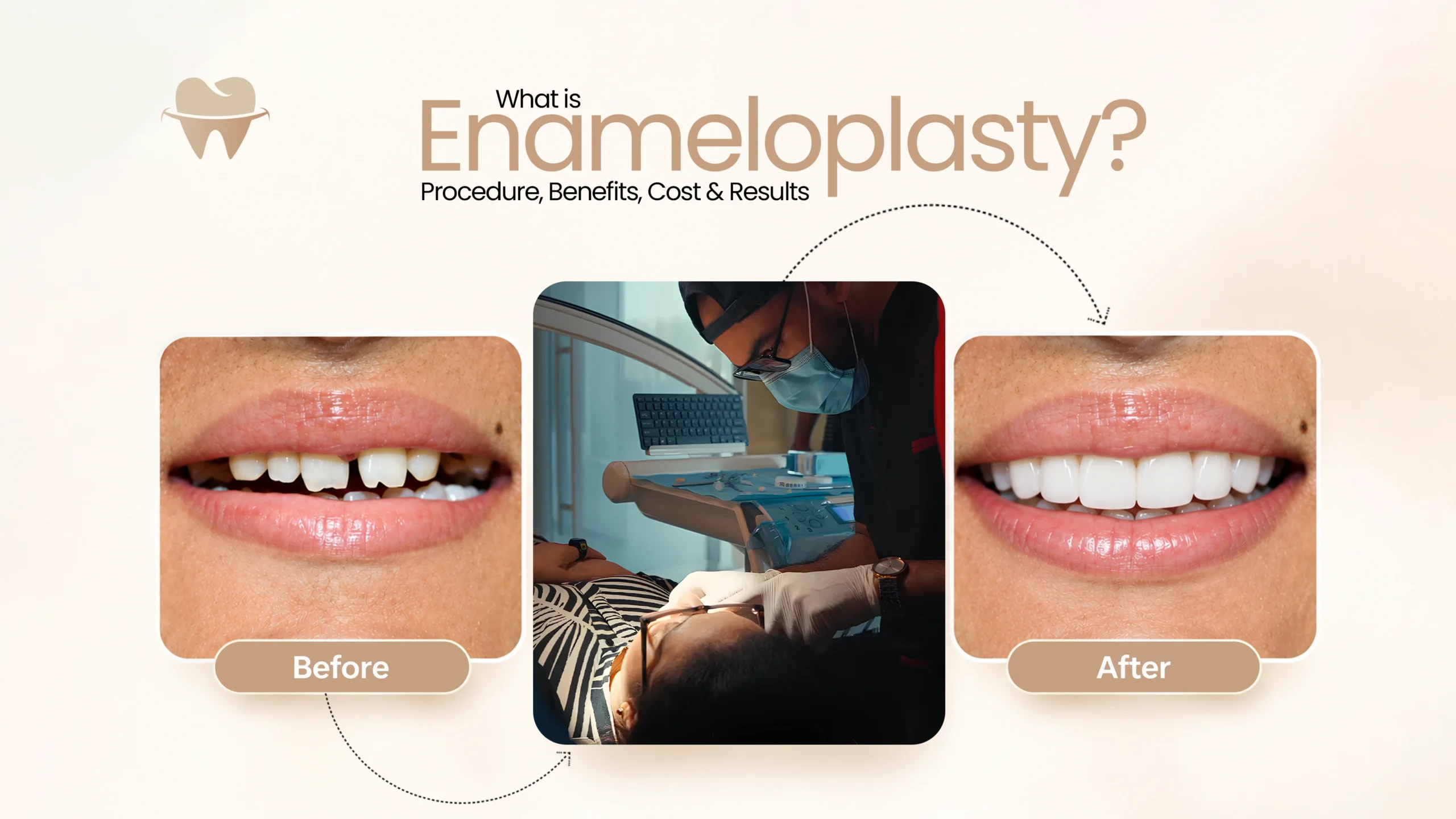 What Is Enameloplasty What Is Enameloplasty