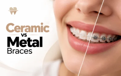 Ceramic vs Metal Braces: Which Is Better for Your Smile?